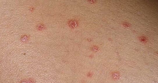 Placas psoriáticas