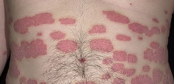 Psoríase
