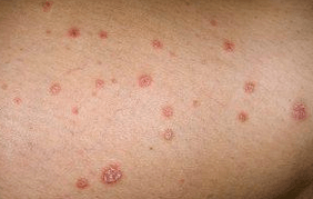 Placas psoriáticas