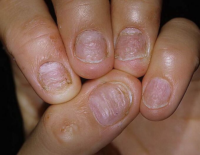 Psoríase de unhas