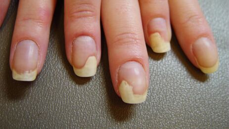 Manchas brancas nas unhas devido à psoríase