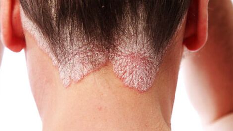 Placas psoriáticas no couro cabeludo