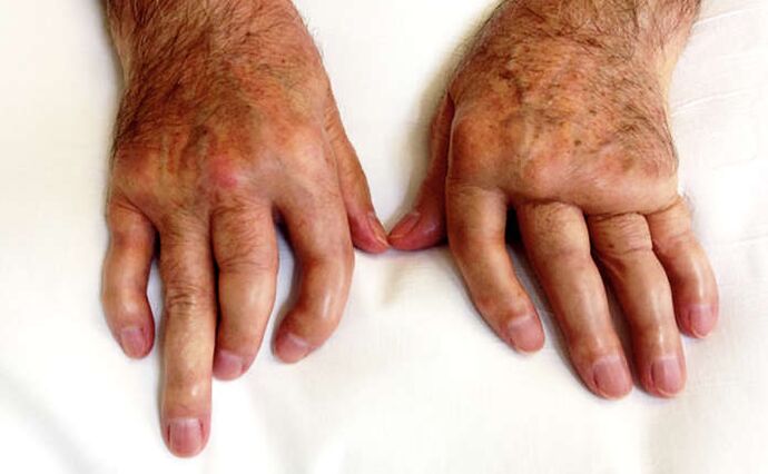 Artrite mutilante na psoríase