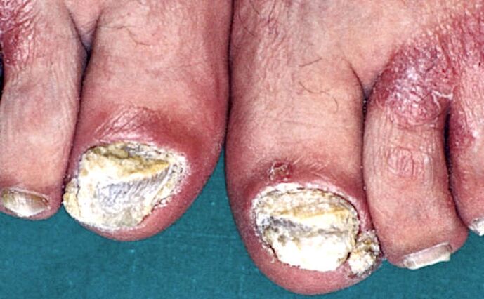 Hiperceratose subungueal grave e placas psoriáticas nos dedos dos pés