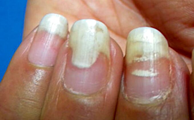 Onicólise e leuconíquia após manicure