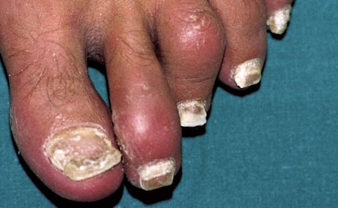 Psoríase com envolvimento das unhas e inflamação das articulações (artrite) dos dedos dos pés
